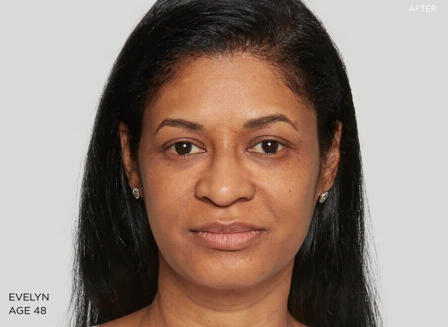 Example 1 after Sculptra treatment