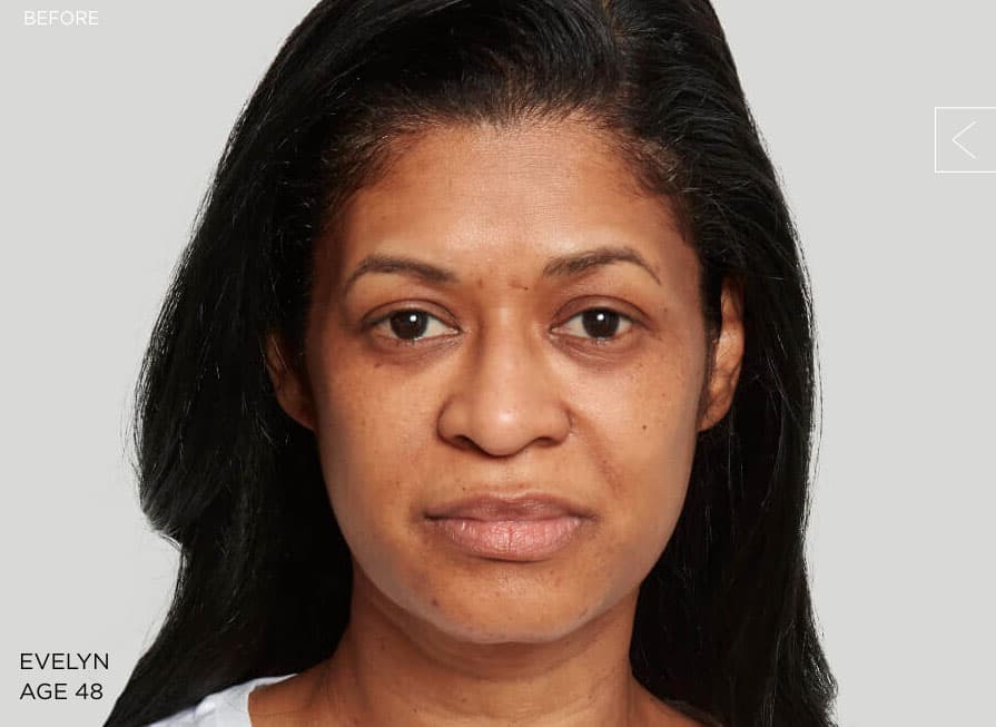Example 1 before Sculptra treatment