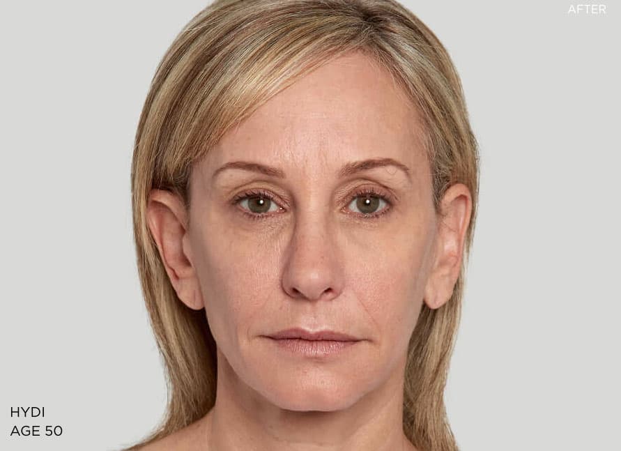Example 2 after Sculptra treatment