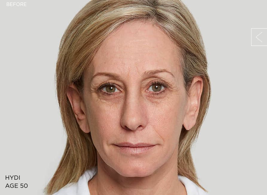 Example 2 before Sculptra treatment
