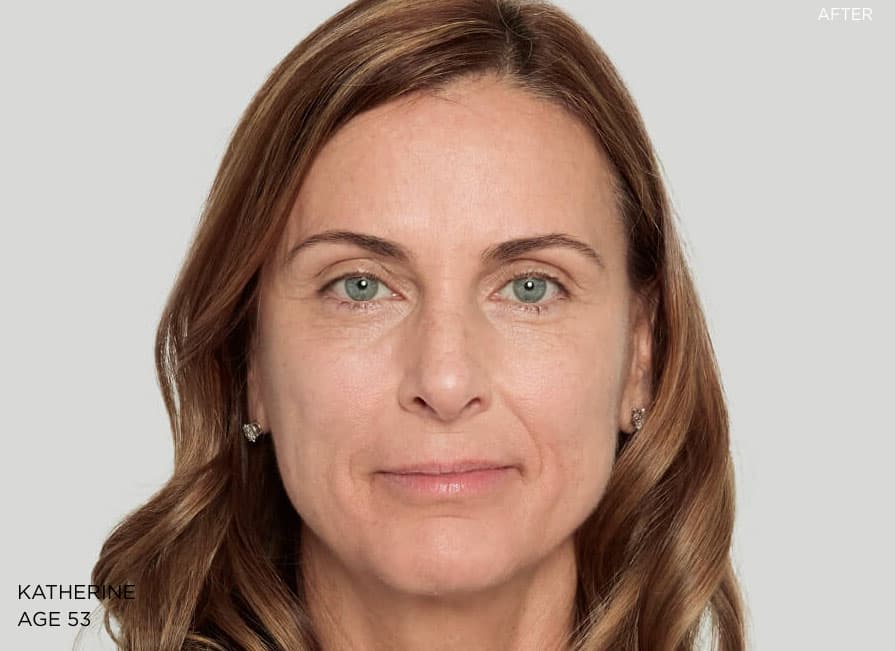 Example 3 after Sculptra treatment