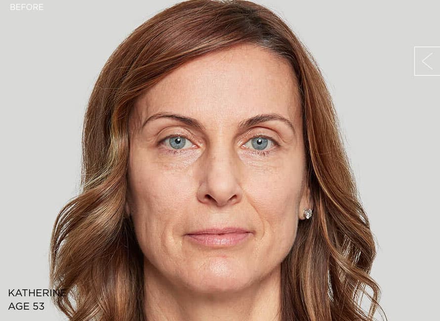 Example 3 before Sculptra treatment