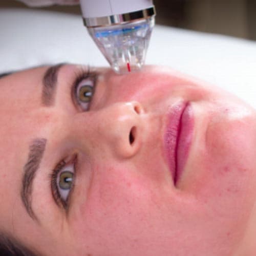 Intensif Microneedling RF treatment in New Braunfels and Spring Branch, TX